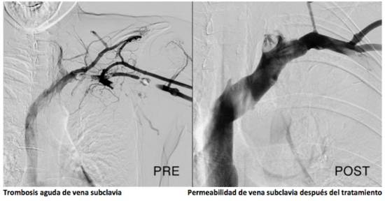 Permeabilidad de vena subclavia después del tratamiento