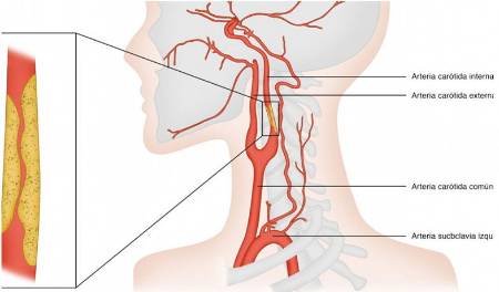 Estenosis carotídea: ilustración