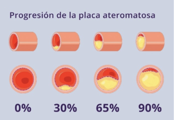 Estenosis carotídea