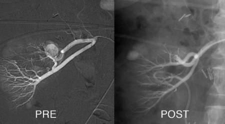 Aneurisma-de-arteria-renal-tratado-con-embolización-selectiva-1080x599
