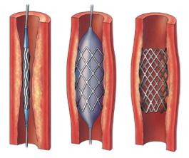 Stent