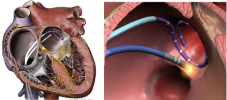 Fibrilación auricular