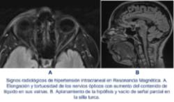 2022 04 04 Hipertensión intracraneal idiopática 2