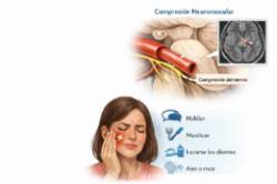 2025 12 23 Neuralgia del trigémino