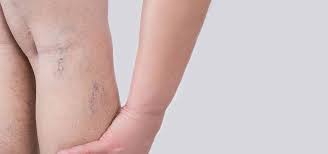 Síndrome de piernas inquietas y varices