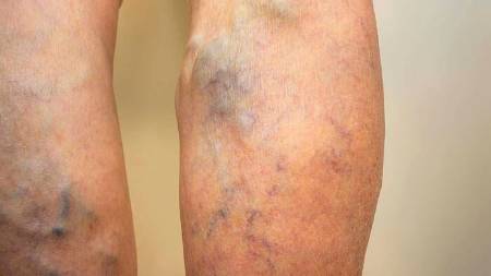 Tromboflebitis