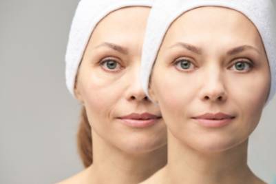 Blefaroplastia