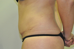Cirugía mínimamente invasiva de la pared abdominal: Hernias, Eventraciones  y Diástasis de rectos - Cirugía Laparoscópica Madrid