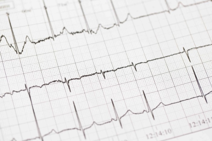 close-up-of-ecg-electrocardiogram-the-work-of-a-2026-03-17-04-14-44-utc