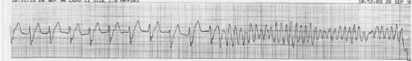 Muerte súbita por fibrilación ventricular