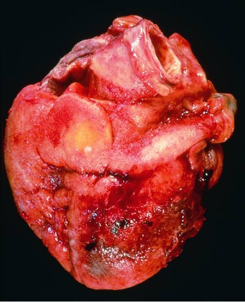 Aspecto macroscópico de una pericarditis aguda