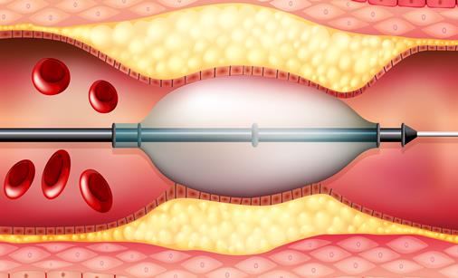 Interior de un stent coronario