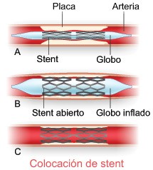 Implantación del stent coronario