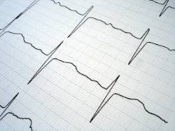 Imagen de un ecocardiograma
