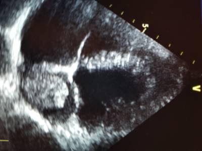 tumors2_imagen_ecocardiográfica_tumor_cardíaco_aurícula_izquierda