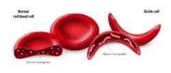 2025 08 04 La anemia de células falciformes (2)