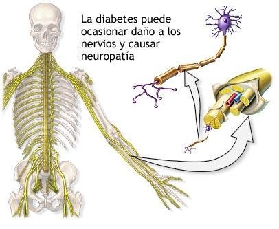 La diabetes puede provocar neuropatías