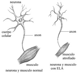 Dolor y ELA