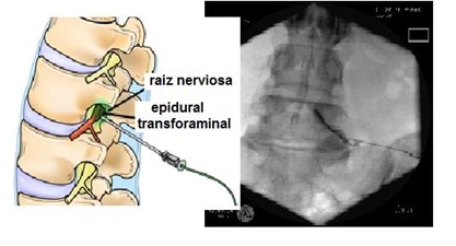 epidural5