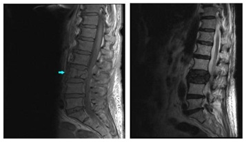 RNM vertebral