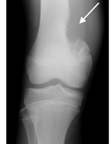 osteosarcoma2