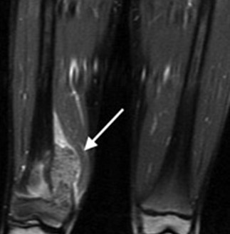 osteosarcoma3