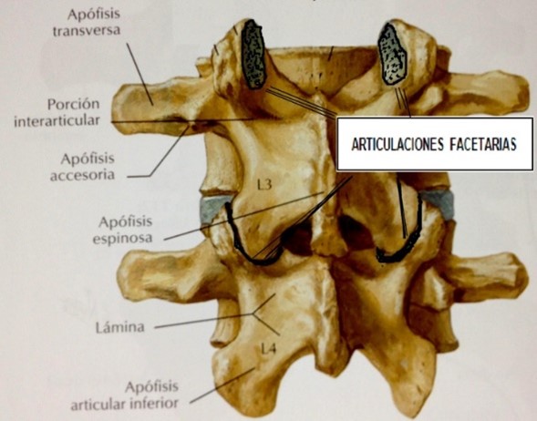 Síndrome facetario
