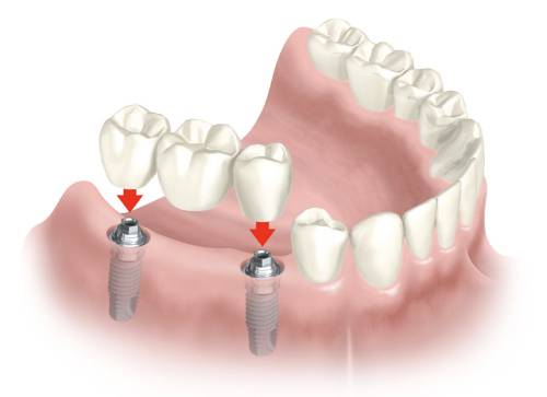Calidad de los implantes dentales