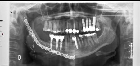 Reconstrucción mandibular