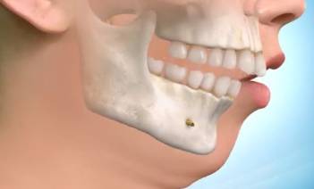 Avance mandibular