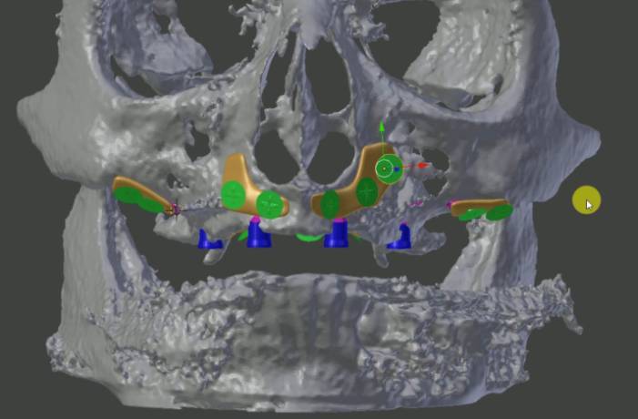 Implantes subperiósticos