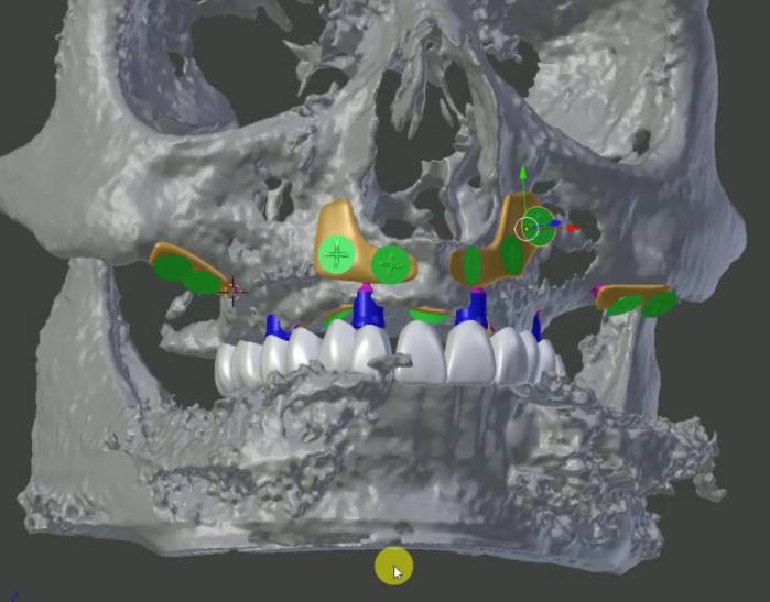 Implantes subperiósticos