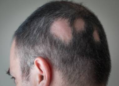 Alopecia Areata