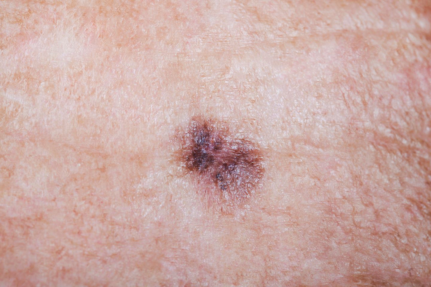 Melanoma