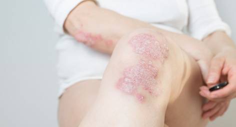 Psoriasis