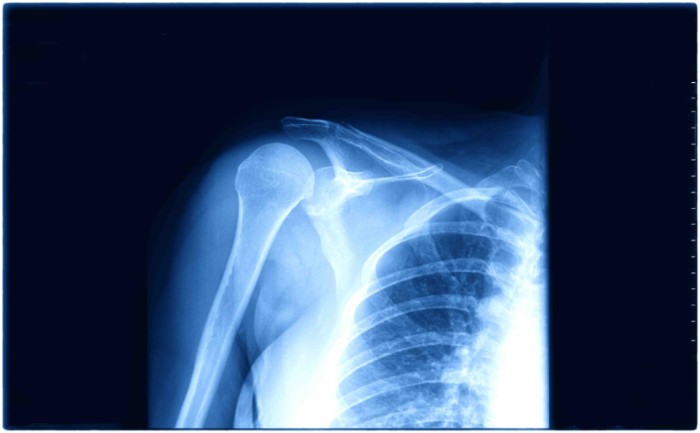 lesion labrum