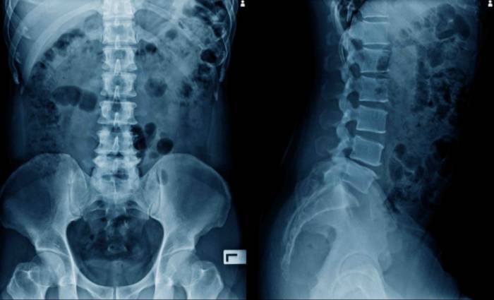 hernias_discales_quirónsalud_torrevieja