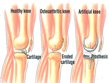 Rodilla