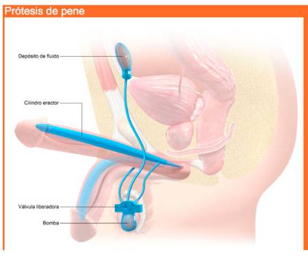 Disfunción-Erectil-Medicina-Sexual-16