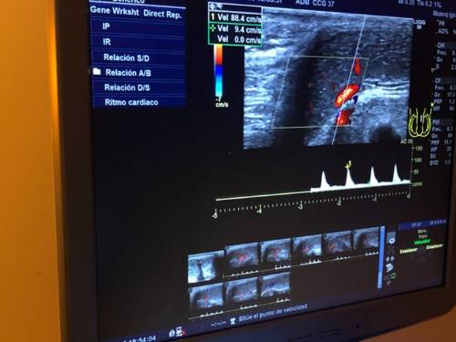 ecografía doppler