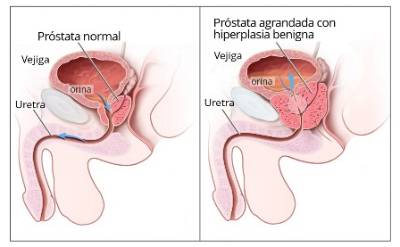 Cuando la Próstata va Creciendo