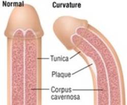 Enfermedad de la Peyronie_1