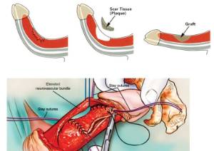 Enfermedad de la Peyronie_2
