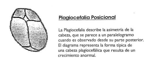 plagiocefalia