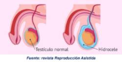 2021 02 01 Lo que debes de conocer del hidrocele 1