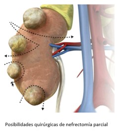 2021 11 18 Doctor, tengo cáncer de riñón 3