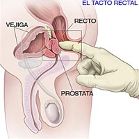 2024 06 18 Tacto rectal 2