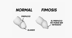 2021 08 30 Fimosis (1)