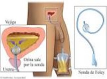 2022 06 20 Sonda vesical 1