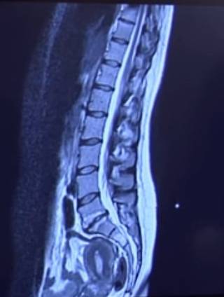 Artroplastia discal lumbar